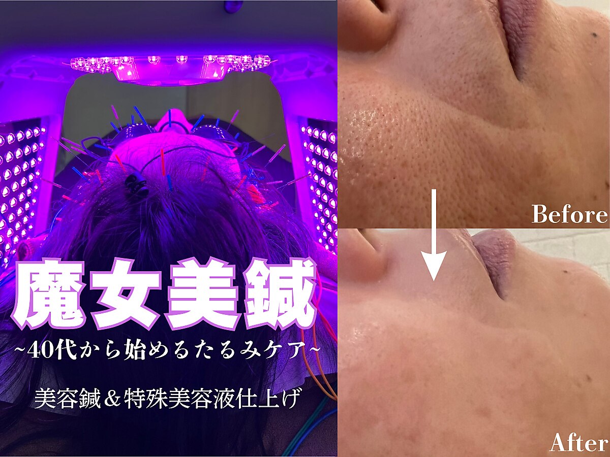 施術者・中村光輝｜HARISの完全個室で美容鍼灸施術を行う様子